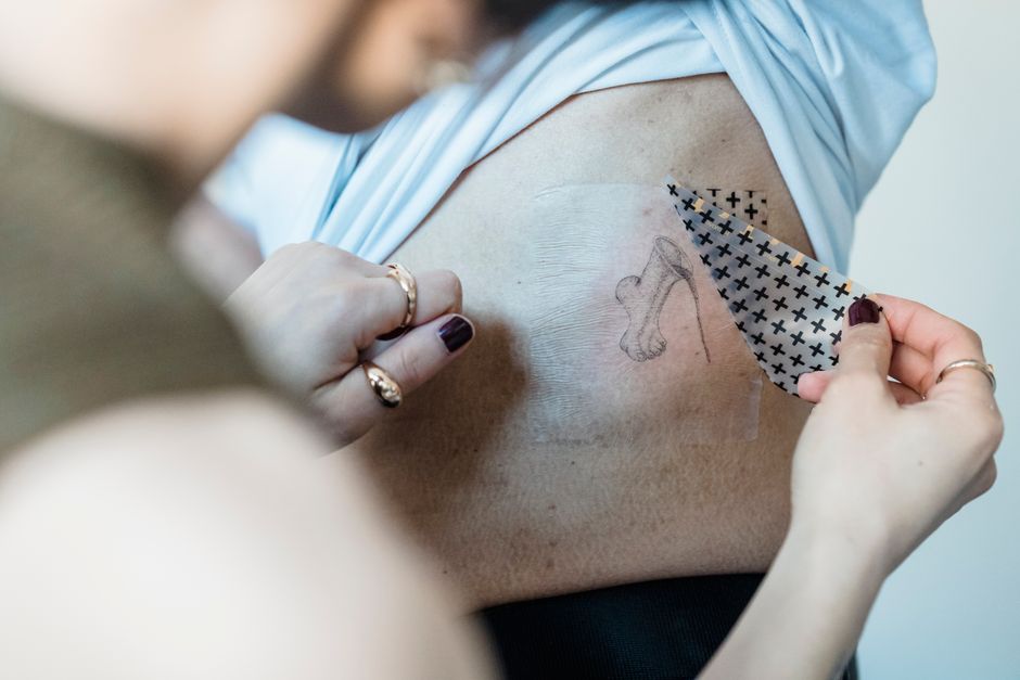 eliminación tatuaje láser
